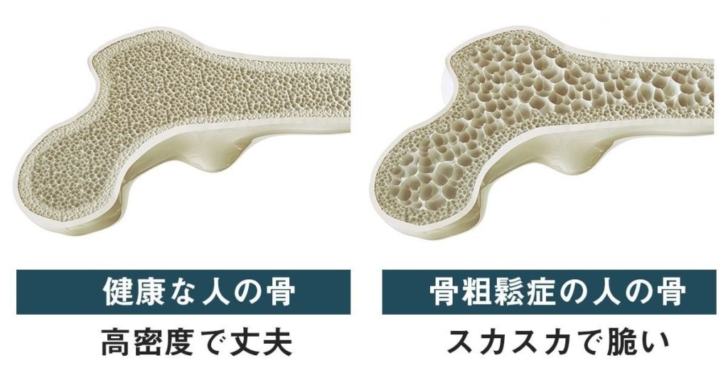 もち麦で骨粗鬆症ケア がん予防